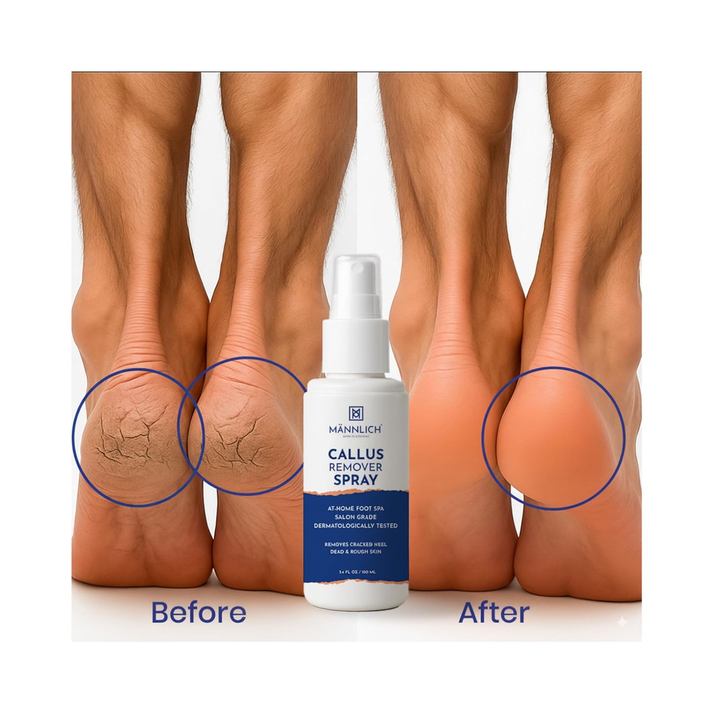 Mannlich Callus Remover -100ml
